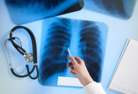 Есть ли угроза эпидемии туберкулеза в Азербайджане?