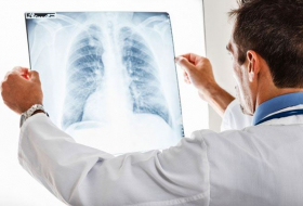 В Азербайджане уменьшилось число больных туберкулезом
