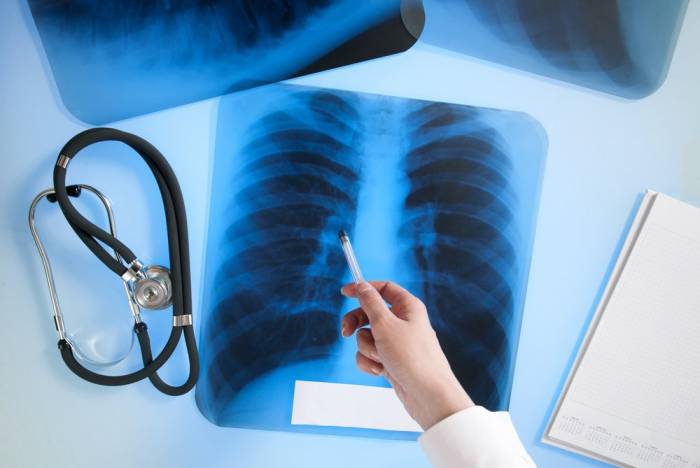 Есть ли угроза эпидемии туберкулеза в Азербайджане?