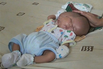 В Индонезии родился ребенок с двумя лицами - ВИДЕО