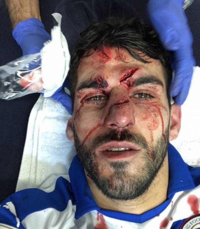 Футболисту наступили бутсой на лицо и изуродовали его - ФОТО
