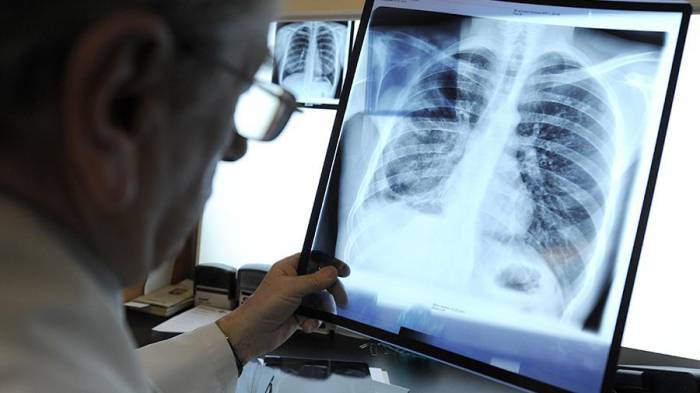 В Азербайджане резко сократилась смертность от туберкулеза
