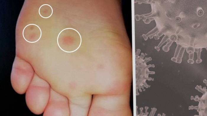 Медики нашли симптом COVID-19 на ногах
