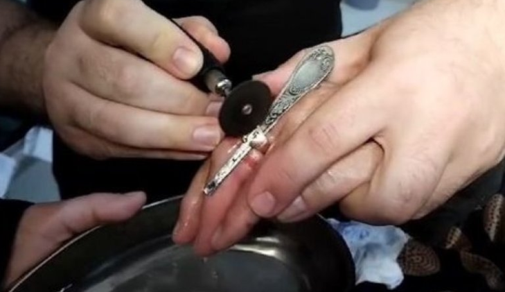 В Баку сотрудники МЧС сняли с пальца женщины застрявшее кольцо