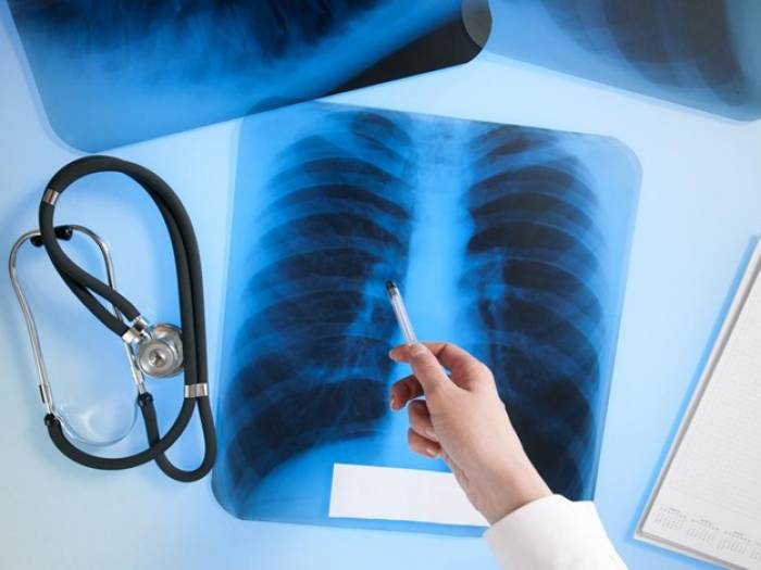 Могут внести изменения в закон "О борьбе с туберкулезом"