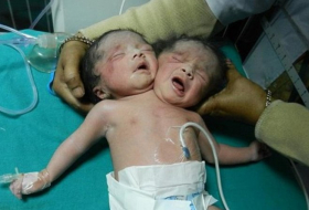 В Бангладеш родился ребенок с двумя головами - ФОТО