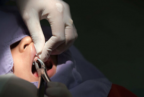 В Германии стоматолог побил рекорд, удалив зуб пациенту
