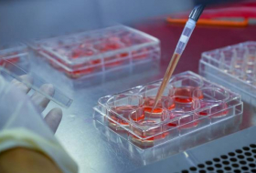 Ученые провели первую фазу испытаний клеточной терапии рассеянного склероза

